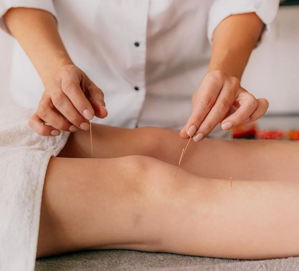 A practitioner placing acupuncture needles during a Traditional Chinese Medicine treatment
